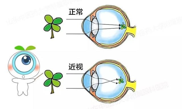 【EyePlus聚英視光眼科】角膜塑型片推薦，矯正視力So Easy！夜晚配戴，還你白天好視力～ @捲捲頭 ♡ 品味生活
