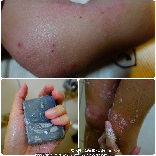 夏天到，皮膚問題到→手工皂舒緩肌膚問題！ @捲捲頭 ♡ 品味生活